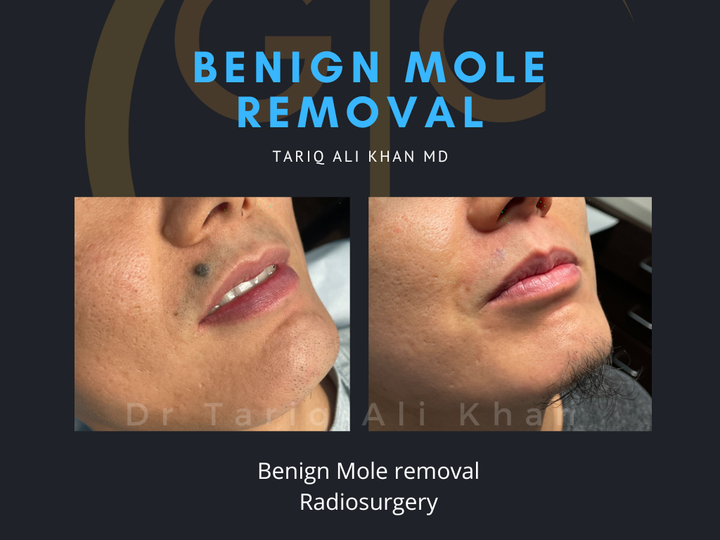 Gentle Care Laser Tustin Before and After picture - Mole Removal